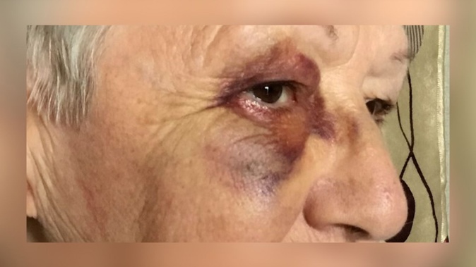The victim of the alleged assault at the Posie Parker #LetWomenSpeak event in March in Auckland. Photo / Supplied