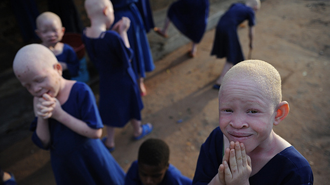 Children with albanism (Getty Images)