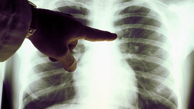 Budget 2026: Bowel cancer screening age to be lowered