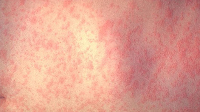 Measles rash spots. (Wikimedia)