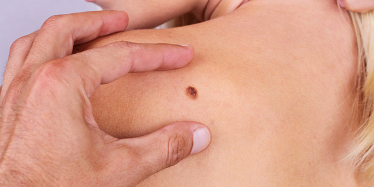 Melanoma New Zealand said the funding is great news for melanoma patients (iStock).