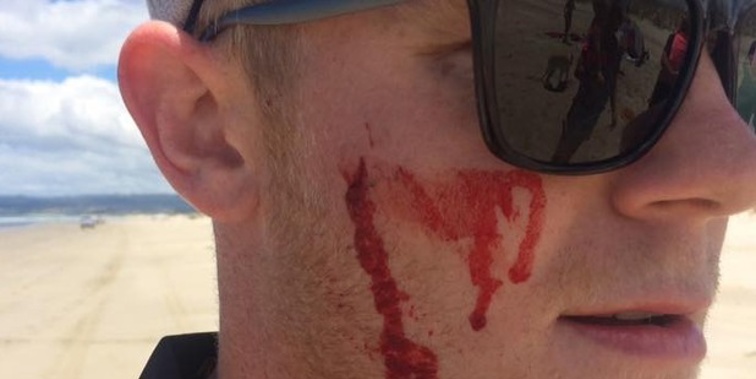 Hadlee bled after he was hit in the face with a baton by a driver on Uretiti Beach. (NZ Herald)