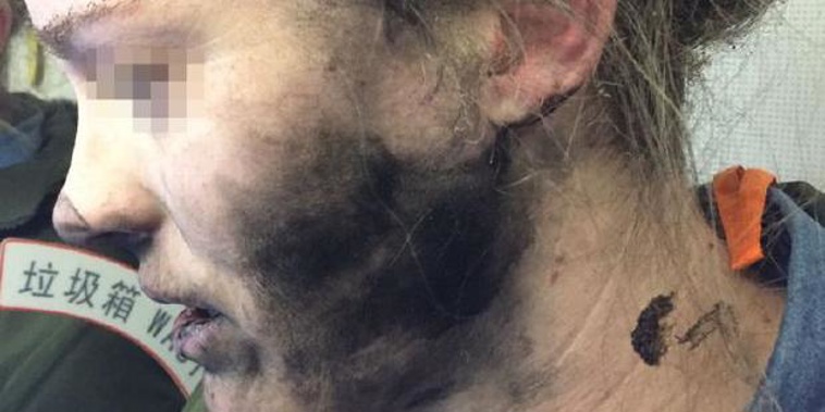The woman's battery operated headphones exploded and caught fire. (NZH)