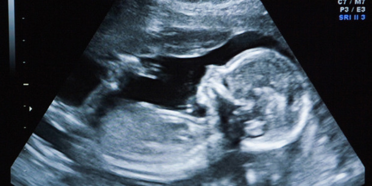 Damning evidence in the UK suggests Primodos hormone tablets, given to more than a million British women, may have caused thousands of severe birth defects and life-threatening abnormalities (Photo / Getty)