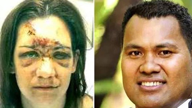 The photo on the left is of Jess Setu after she had received medical treatment following the bashing by Lealofi Setu. 