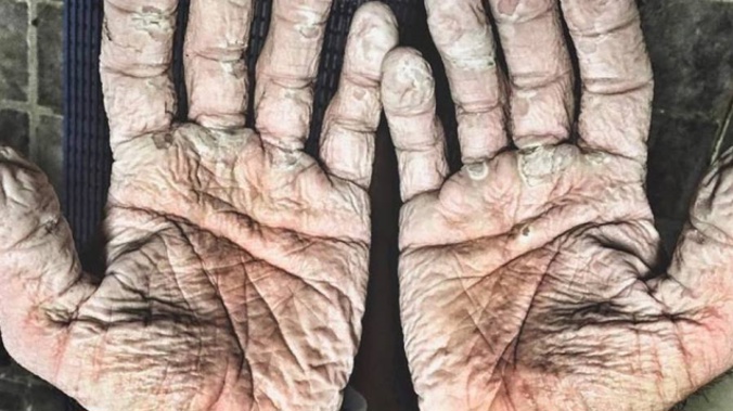 Alex Gregory is a Cheltenham-born double Olympic gold medalist. These are his hands. (Photo: Facebook)