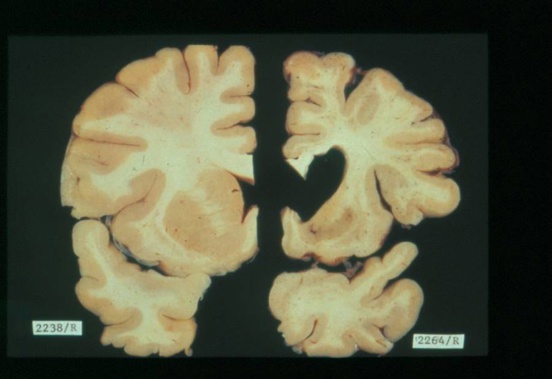 Huntington's disease causes normal brain tissue, on the left, to erode and decrease in size, right