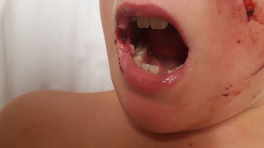 Baldwin was bitten on his cheek and lip in the attack. (Photo \ Supplied)