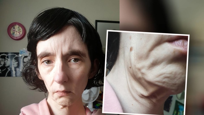 Anna Mills, 38, weighed just 35kg when her sister took her out of an IDEA Services residential care home and lodged complaints with the Health and Disability Commissioner, Human Rights Commission, and Ombudsman. Photo / Supplied