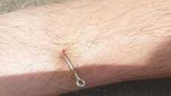 Jan Higgins' son got a longline fishing hook in his leg that had to be removed at the hospital.