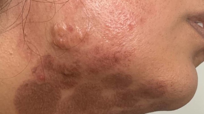 An Auckland woman's skin was burnt during a laser hair removal session