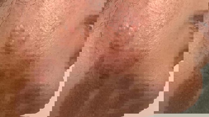 An Auckland woman's skin was burnt during a laser hair removal session