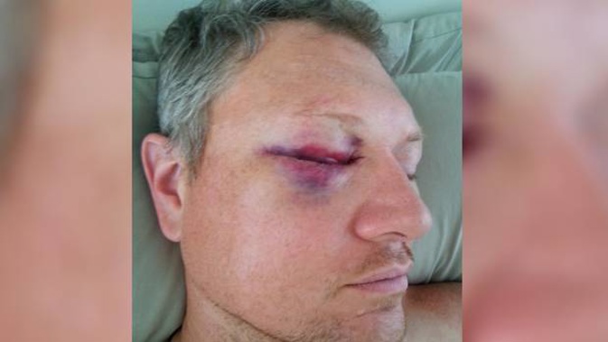 Derek Tanner's eye socket was smashed to pieces in the ambush attack and his eyesight threatened. Even after surgery, he faces a heightened risk of losing sight as he ages. (Photo / Supplied)