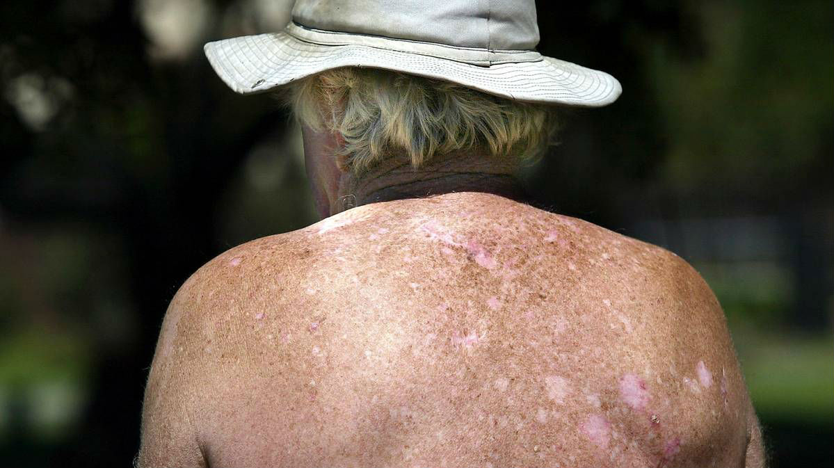 New Zealand's dismal cancer statistics have been highlighted in a global index, putting the country proportionally second worst for new cases. (Photo 123RF)