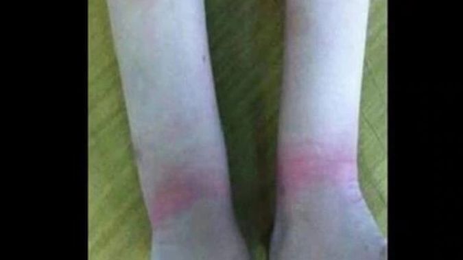 Madisyn Wordlow's wrists after being handcuffed. (Photo / Supplied)