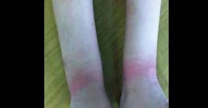 Madisyn Wordlow's wrists after being handcuffed. (Photo / Supplied)