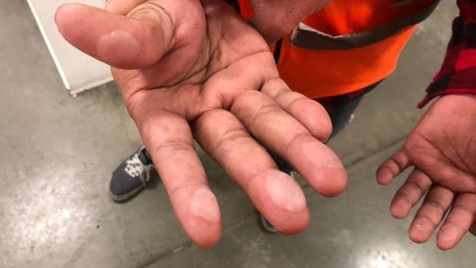 E tū says workers are getting calluses and blisters on their hands from long-hours and hard work at Sistema. (Photo / E tū)