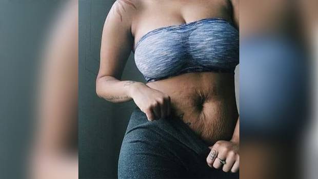 A woman who was slammed by men for her stretch marks has been praised as an 'inspiration' by women who struggle to deal with post-pregnancy. Photo / Facebook