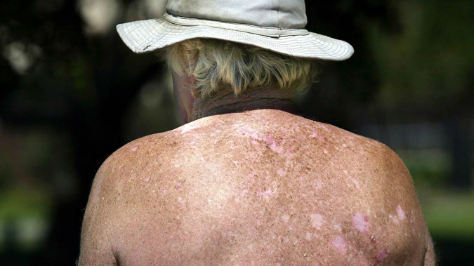 He said it is worrying because New Zealand has the highest incident rate of melanoma in the world. Photo / NZ Herald