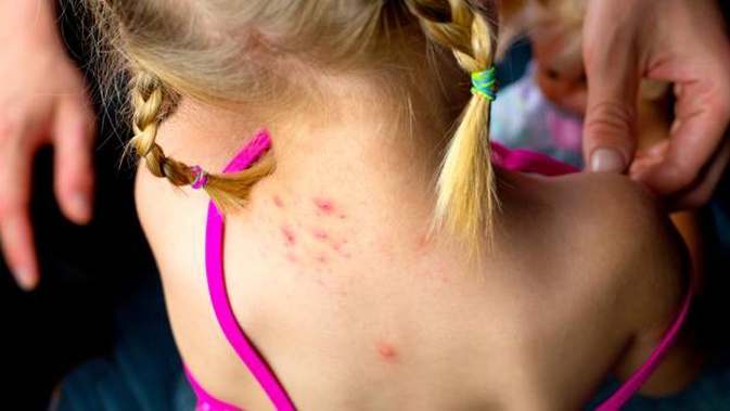 Around half of children in South Auckland are declined a specialist appointment for serious skin conditions. Photo / File