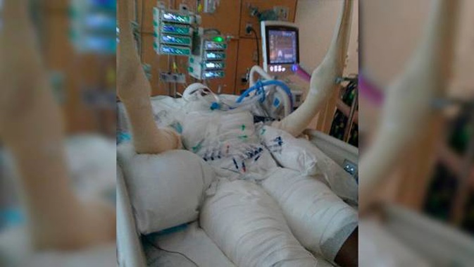 The victim is in the hospital with burns to half of her body after setting herself on fire on Friday as part of the 'Fire Challenge'. Photo / Facebook