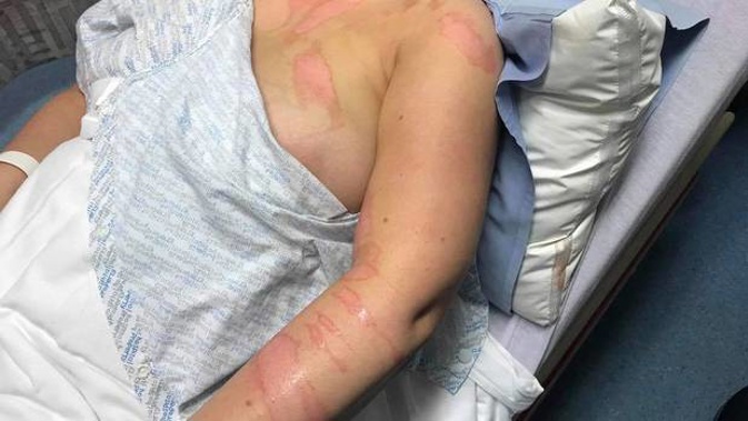 Injuries suffered by a nurse who allegedly had boiling water thrown over her. Photo / Facebook 