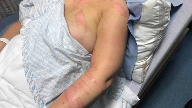 This nurse suffered second-degree burns when a patient poured boiling water on her.