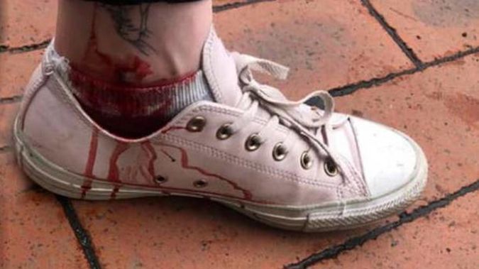 Jo Wilson's bloodied ankle after a Lime scooter mishap. (Photo / Supplied)