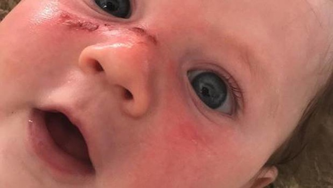 Noah - four months old - suffers horrific blister burns after Cancer Society 50 SPF sunblock fails to protect him from NZ's harsh rays. Photo / Supplied