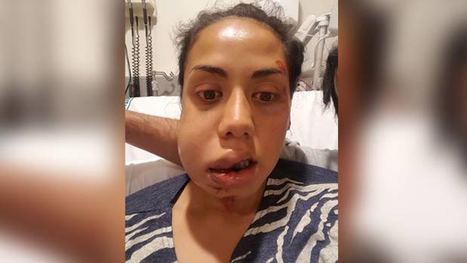 Raven Torea's face was badly swollen after the attack. (Photo / Supplied)