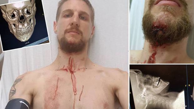 Liam Thompson, 27, went over the handlebars of a Lime scooter. Photos / Supplied.