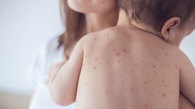 Signs of measles include fever, cough and a runny nose. Photo / Getty Images