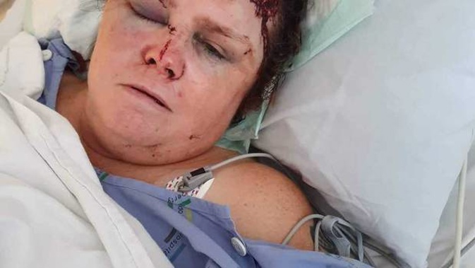 The security guard, pictured the day after she was brutally assaulted by a patient last month, faces a long road to recovery. (Photo / Supplied)