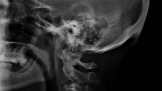 The study involved 218 X-rays of people aged between 18 and 30-years-old on the Sunshine Coast and found that 41 per cent had developed a 10 to 30 millimetre bony lump at the back of their skull.
