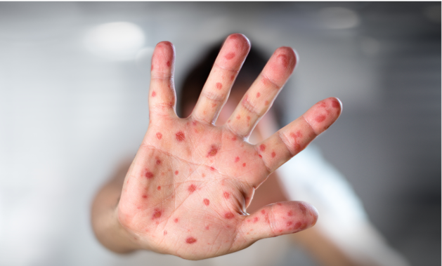 Eight adults and seven children are currently in hospital with the disease.