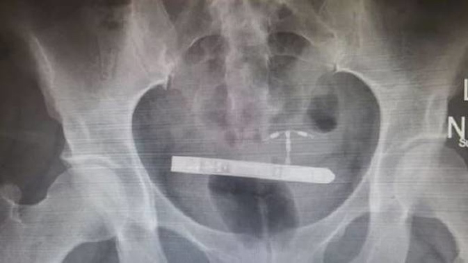 The sex toy became lodged in her bladder and had to be removed by surgery. (Photo / Supplied)