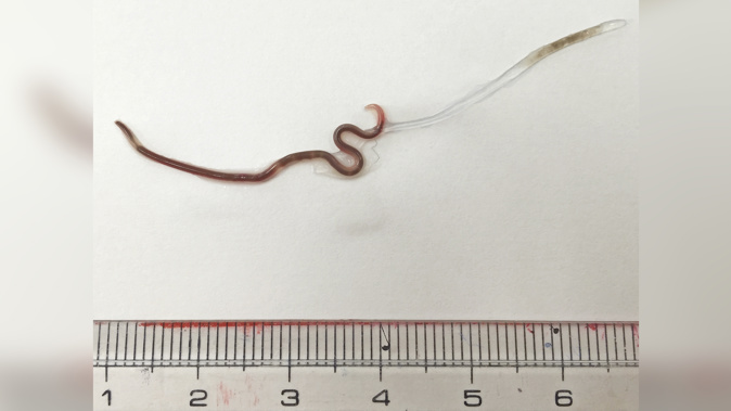 The worm was 1.5 inches long. Credit: The American Journal of Tropical Medicine and Hygiene