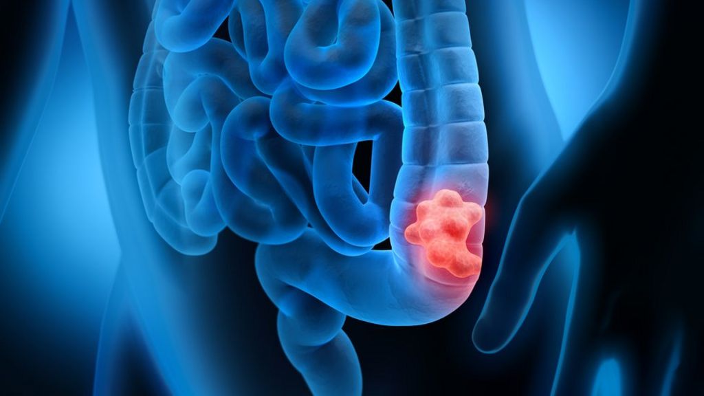 "It would be really transformational": Report highlights need to lower bowel cancer screening age 