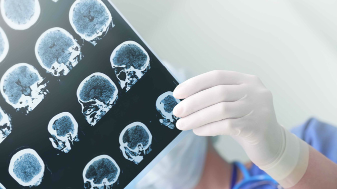 People who have had Covid-19 may have an increased risk of being diagnosed with a psychiatric disorder such as anxiety or depression, according to a new study. (Photo / Shutterstock)