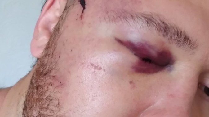 The woman's son suffered a swollen black eye and bleeding iris in the attack,which put him in hospital. Photo / Supplied