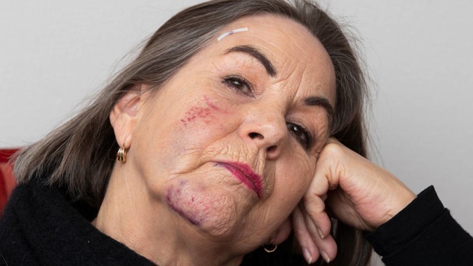 Debra Christensen with head injuries after a Lime scooter crash knocked her out in June 2019. Photo / Brett Phibbs