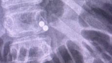 Temu distances itself from 13-year-old boy who swallowed 100 magnets