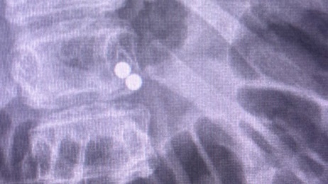 Temu distances itself from 13-year-old boy who swallowed 100 magnets