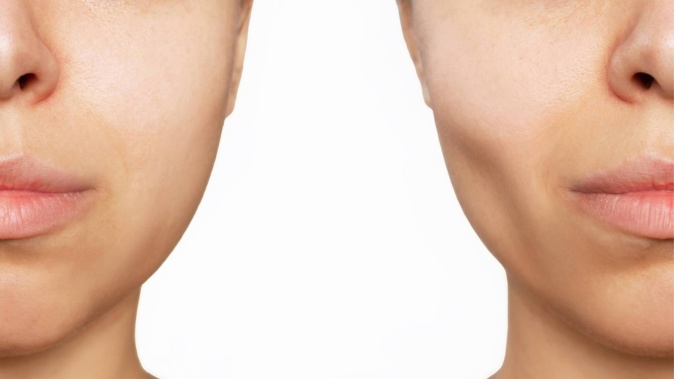 Before and after the procedure. Photo / Getty