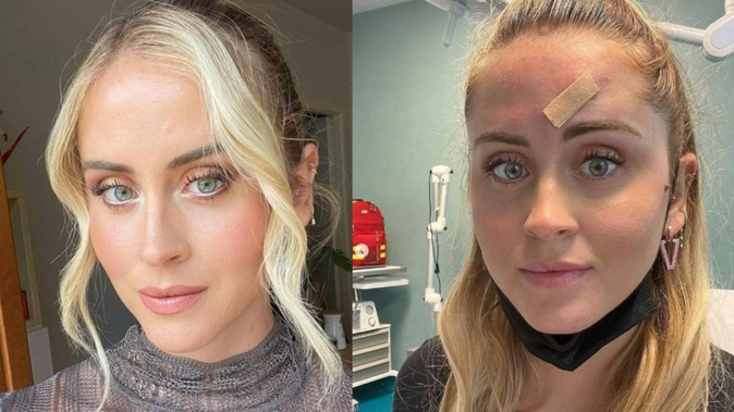Model Valentina Ferragni, 30, shared photos of the spot on her forehead that turned out to be skin cancer. Photos / @valentinaferragni