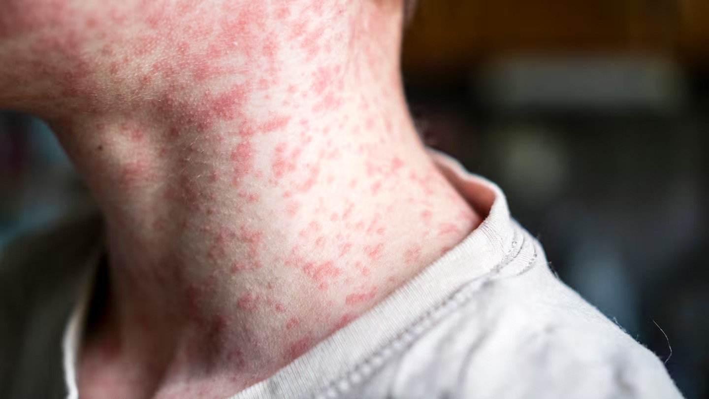 Contact tracing is the key to stopping the measles outbreak. Photo / Getty Images