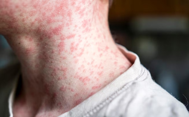 Health NZ says measles outbreak far from over as vaccination drive ramps up