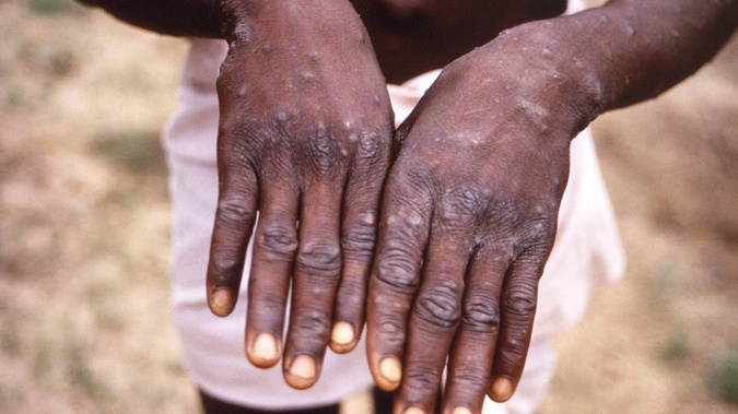 This 1997 image provided by the CDC during an investigation into an outbreak of monkeypox, which took place in the Democratic Republic of the Congo (DRC). Photo / File