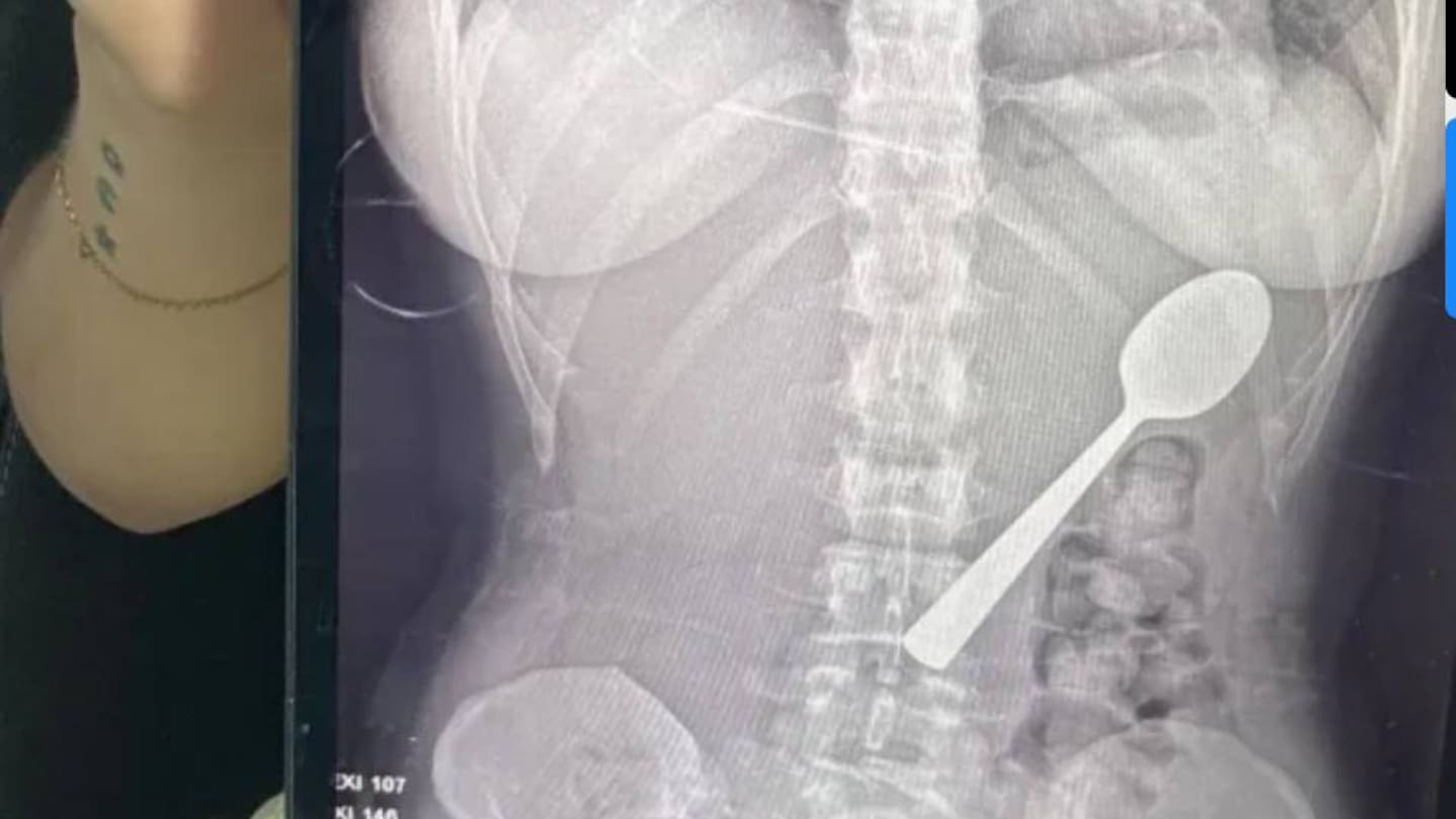 ‘Either swallow or choke’: Woman undergoes surgery after accidentally swallowing utensil