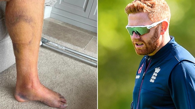 Jonny Bairstow's badly bruised leg after his costly round of golf. Photos / Instagram, Photosport